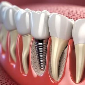 Single Tooth Implant Cost Australia image campbelltown