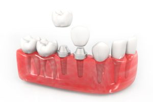 single tooth implant cost australia number of teeth campbelltown