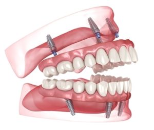 Cost-For-Full-Mouth-Dental-Implants-image-campbelltown