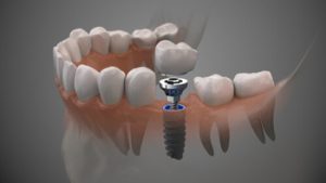 Affordable Dental Implants single campbelltown