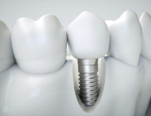 dental-implants-cost-india-illustration-campbelltown