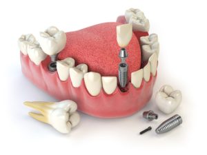 dental-implants-cost-india-number-of-posts-campbelltown