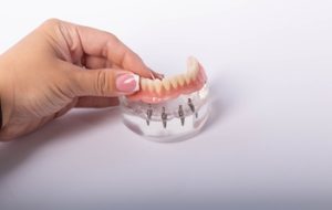 price of entire mouth implants thailand campbelltown