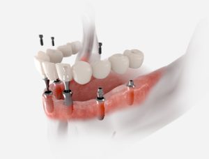 dental implants expenses bali campbelltown