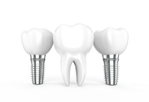 dental implants price campbelltown