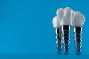 foreign dental implants costing campbelltown