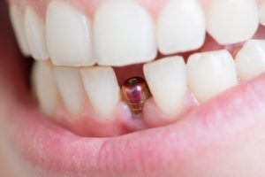 
implant dentist charges philippines campbelltown