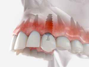 
teeth implant cost bali campbelltown