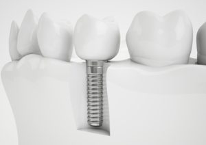 tooth implant overseas expenses campbelltown