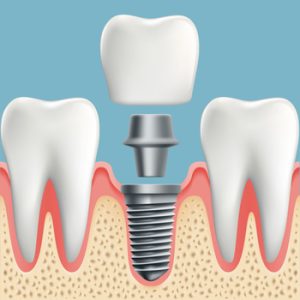 
tooth implants cost bali campbelltown