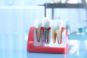 out of the country dental implant campbelltown