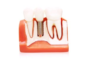 tooth implant overseas campbelltown