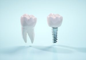 Dental Implants Pattaya missing tooth campbelltown