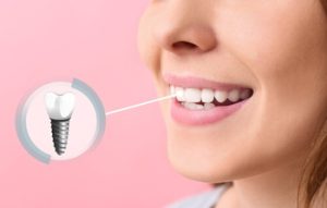 Dental Implants Phuket illustration campbelltown