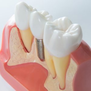 dental-implant-malaysia-appearance