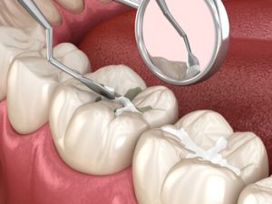 Dental Implant Vs Root Canal therapy