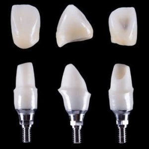 Dental Implants Price Manila crown and posts