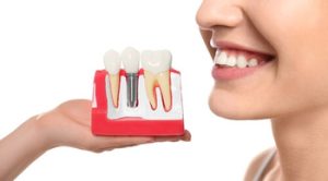 Dental Implants Price Manila posts