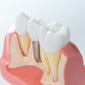 Single Tooth Implant Cost Turkey illustration