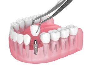 Single-Tooth-Implant-Cost-Turkey-single-tooth