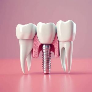 Vietnam-Dental-Implants-Cost-overseas