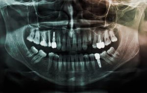 Vietnam Dental Implants Cost xray