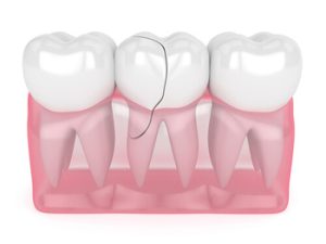 dental implants vs crowns crack