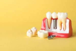 Dental Implants Vs Dentures choice