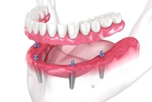 Full Mouth Dental Implants Cost Philippines set