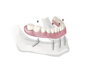 Full Mouth Dental Implants Turkey Price