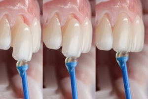 How Do Veneers Work application