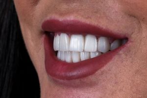 Composite Veneers cost check