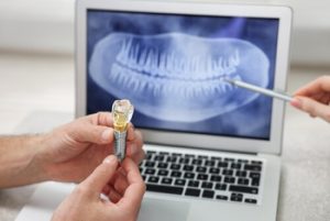 Cost of Dental Implants in Pattaya Thailand explanation