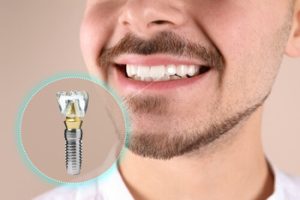 Cost of Dental Implants in Pattaya Thailand post