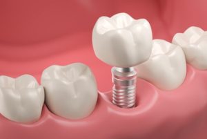 Dental Implant Singapore illustration