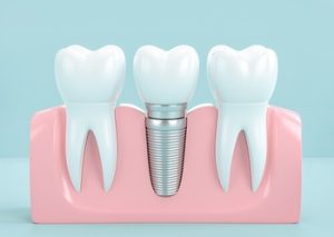 Dental Implant Singapore single