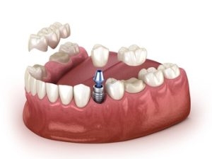 Dental Implants Dubai illustration