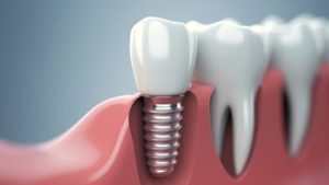 Dental Implants Dubai single