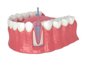 Phuket Dental Implants Cost illustration