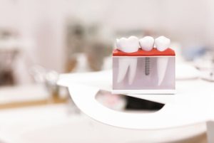 Tooth Extraction and Implant Cost illustration