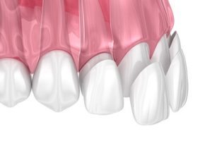 types of veneers application