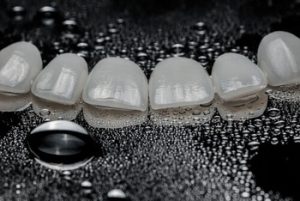 types of veneers shells