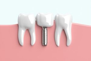 Dental Implant Cost UK illustration