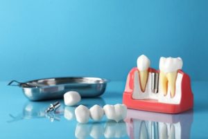 Dental Implant Cost UK procedure