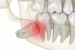 Wisdom Teeth Removal Cost impacted