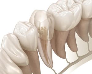 root canal cost procedure