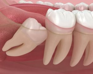 wisdom tooth pain impaction