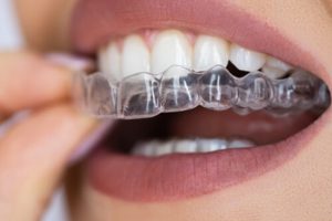 How Much Does Invisalign Cost wear