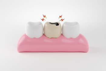Can Tooth Decay Spread neighbor