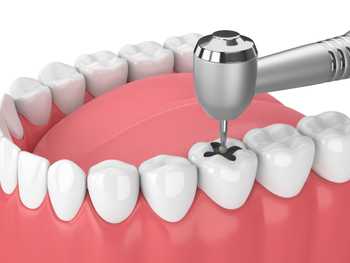 3d,Render,Of,Jaw,With,Teeth,,Dental,Handpiece,And,Drill